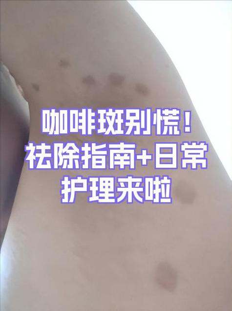 咖啡斑能彻底去除吗