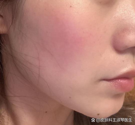 女生脸上有潮红说明什么