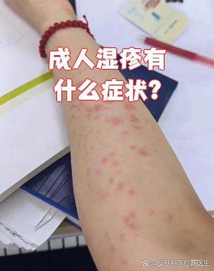 皮肤湿疹的症状图片