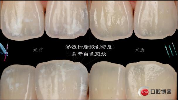 苹果8后盖玻璃有白色斑点