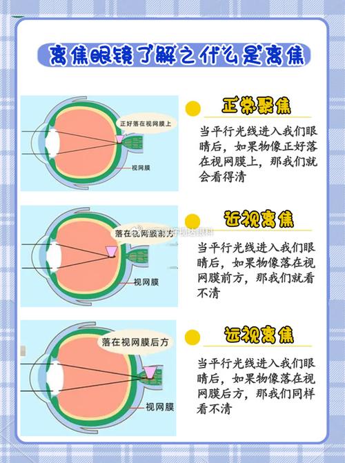 离焦镜需要全天佩戴吗
