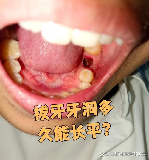 拔牙