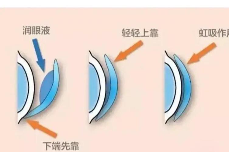 0k镜适合什么人群佩戴图标