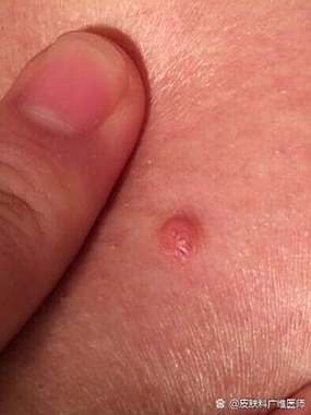 痘痘中间白色四周红色