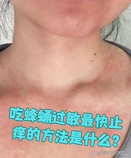 蜂蛹过敏怎么止痒最快