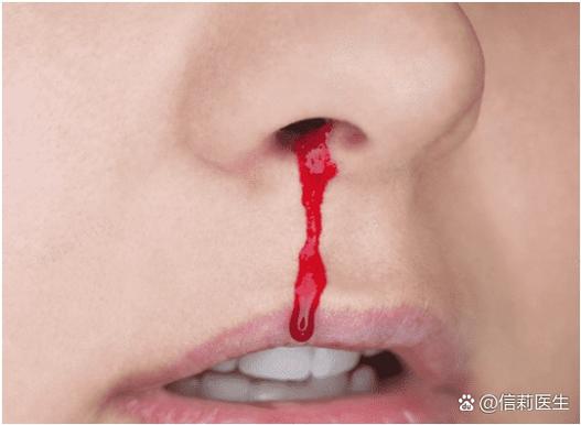 烧电焊流鼻血什么回事