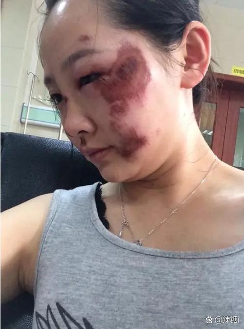 脸上有疤怎么办才能去掉呢缩略图