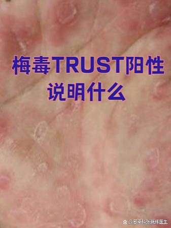 梅毒阳性一定是得了梅毒吗
