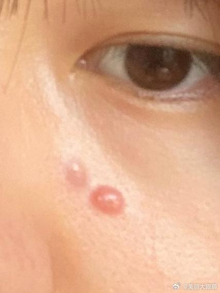 脸上长红包缩略图