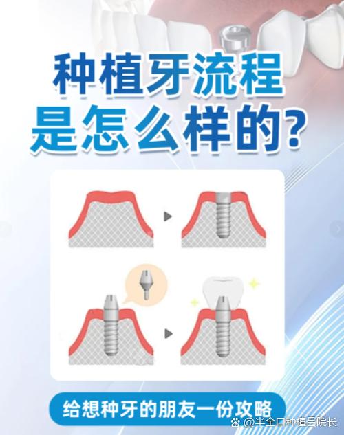种植牙的种类缩略图