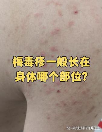 梅毒痘痘长什么样子