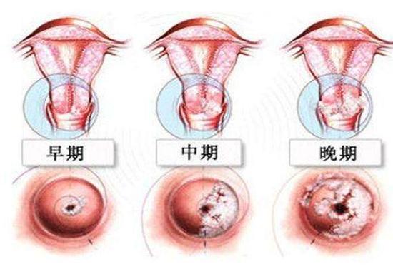 女性hpv病毒早期症状截图