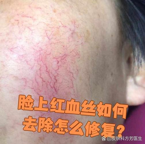 红血丝怎样治好