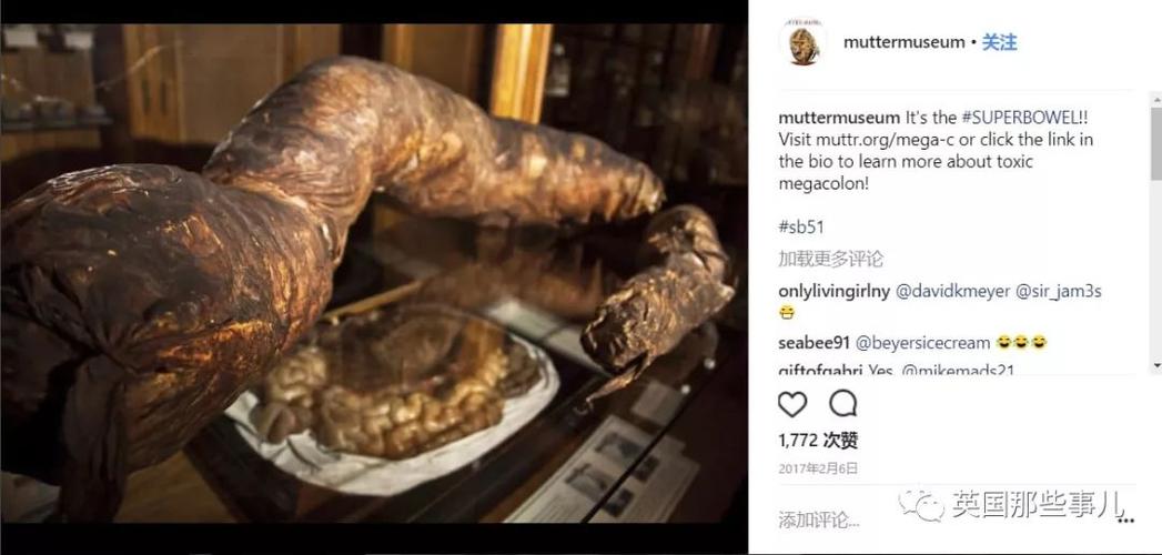 megacolon