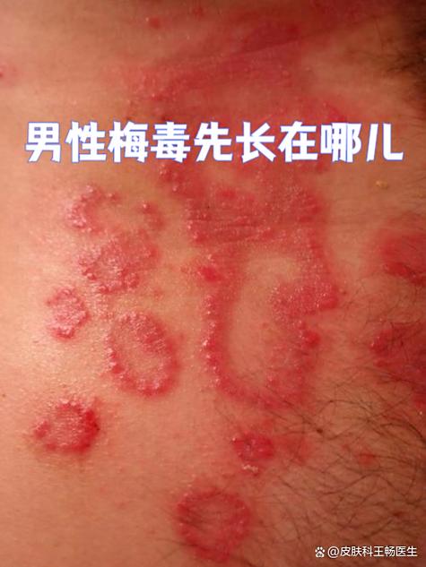 梅毒初期红斑