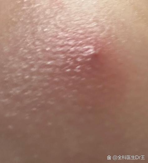 打屁股针留下的硬疙瘩整个腰都疼