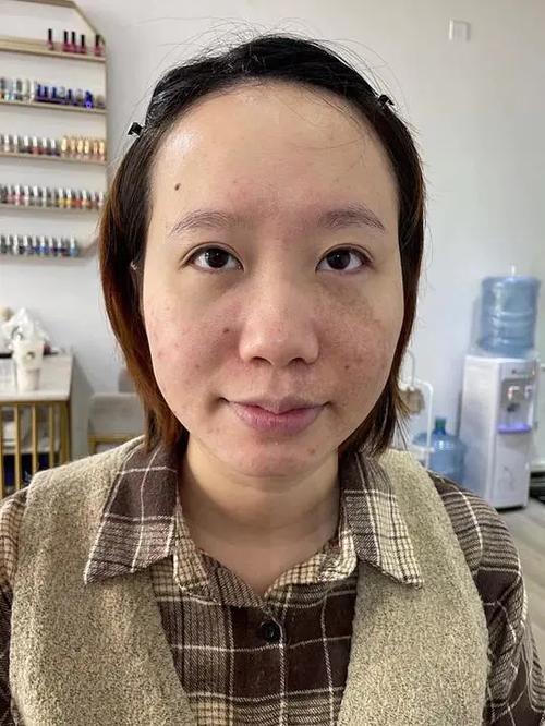中山肤斗士收费贵吗