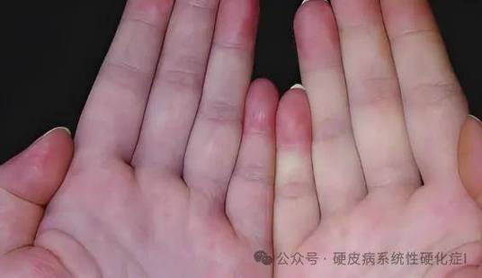 dsdna阳性一定是红斑狼疮吗