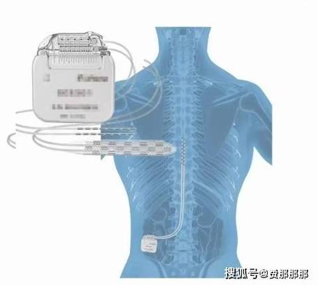 脊髓电刺激手术风险大吗