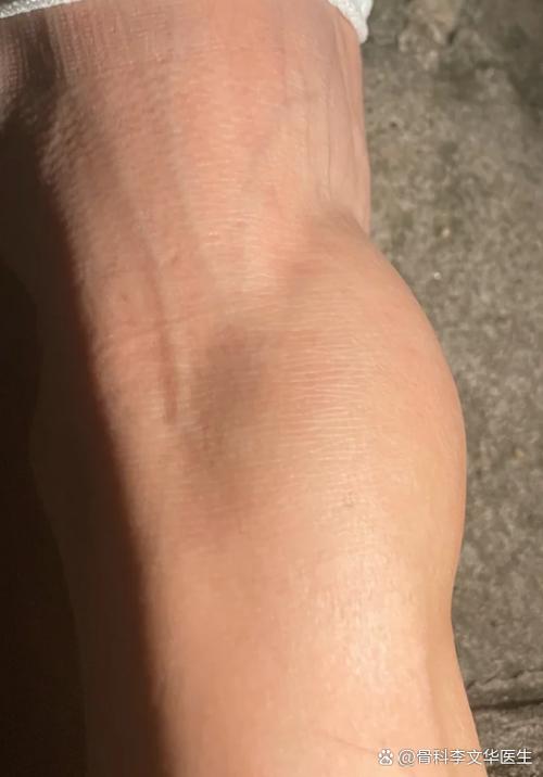 骨头撞了凸起消不下去怎么办
