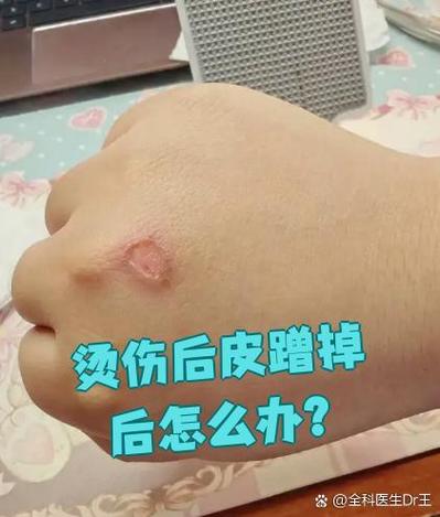 烫伤后三天皮被搓掉了