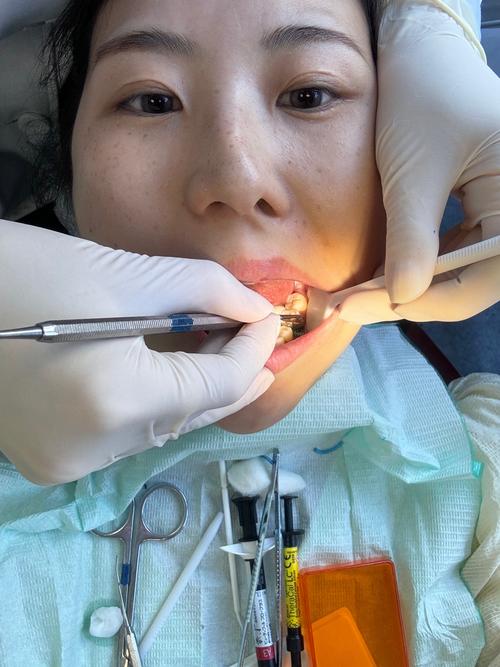 补牙视频