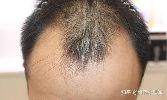 手机怎么p发际线