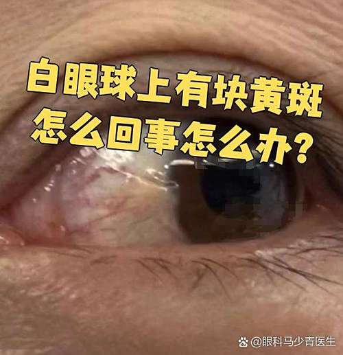 眼白上有一小块黄斑