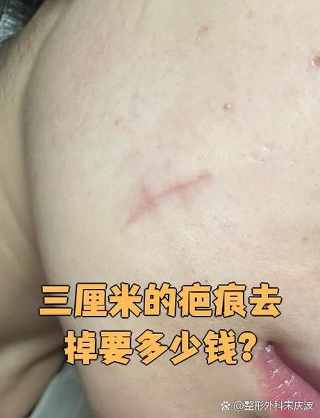 缝针的疤痕能去掉吗