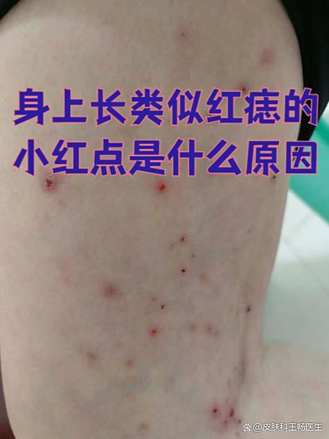 红痣怎么去除小窍门