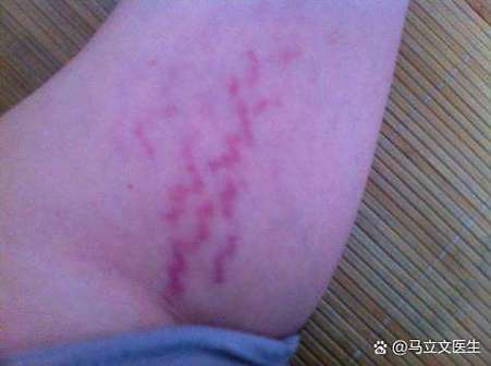 屁股两侧有紫色条纹不痛不痒