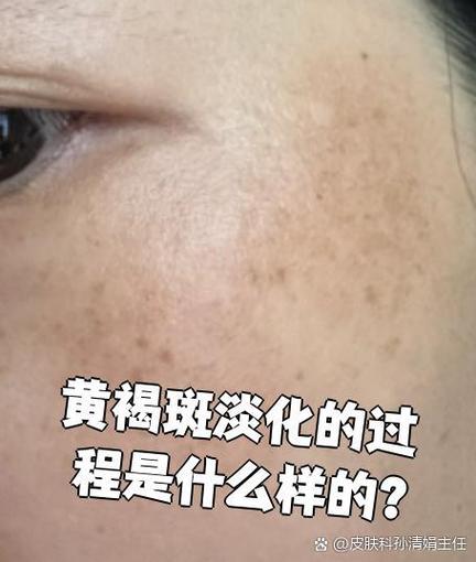 黄褐斑