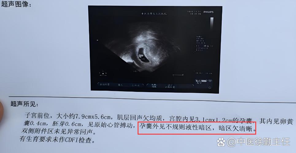孕囊外有液性暗区