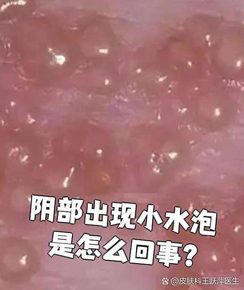 阴侧内壁长水泡