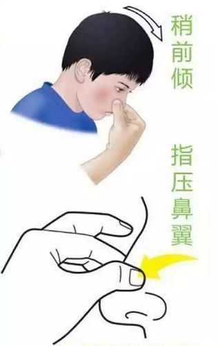 小朋友突然流鼻血是怎么回事