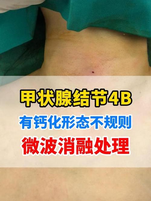 甲状腺结节形态尚规则是什么意思