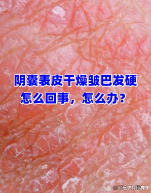 睾丸表皮干燥皱巴发硬