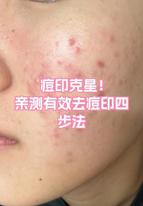 怎么去痘印最快最有效的方法