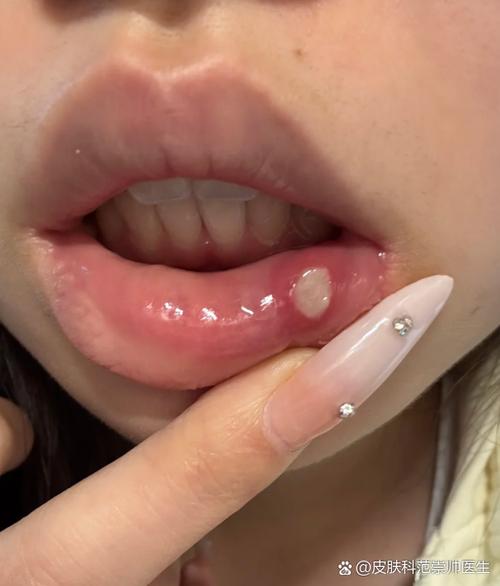 女性经常口腔溃疡原因