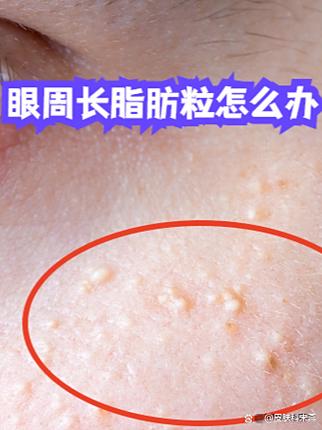 脂肪堆积怎么消除