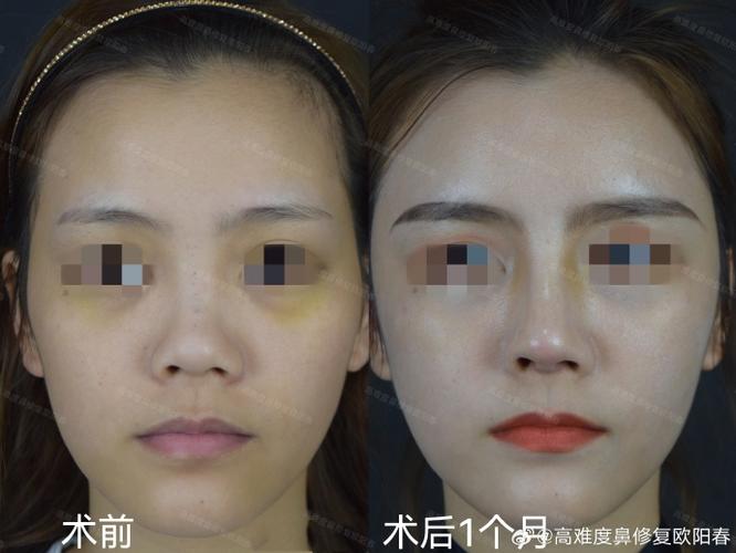 肋骨鼻2年后鼻尖变短了图标