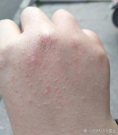 手上长点点的小泡泡是怎么回事