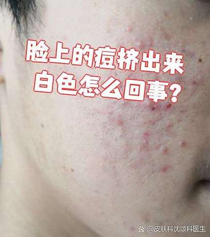 粉刺白点要挤出来吗