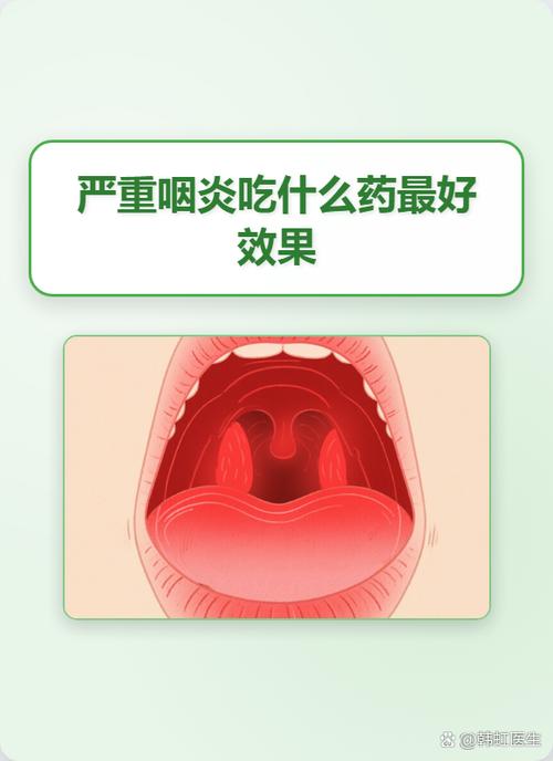 咽喉炎吃什么药最好得快能根治
