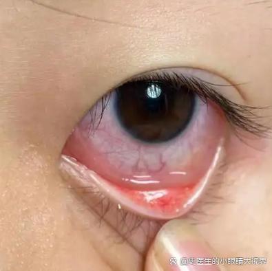 左眼模糊右眼清晰怎么恢复