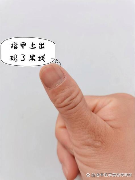 女性食指有黑线要警惕
