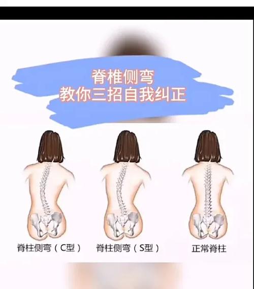 颈椎侧弯怎么矫正