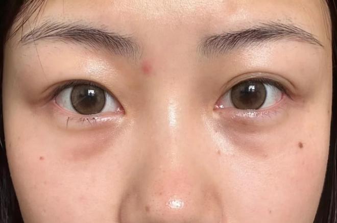 打针去眼袋能保持多久