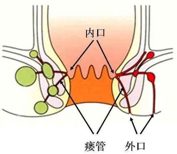 肛门漏屎怎么治
