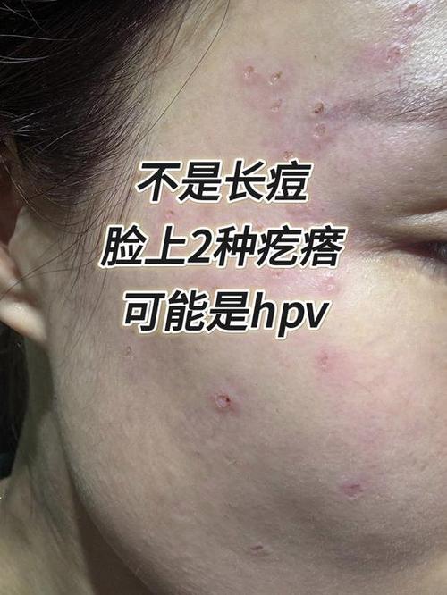 hpv感染的痘痘图片